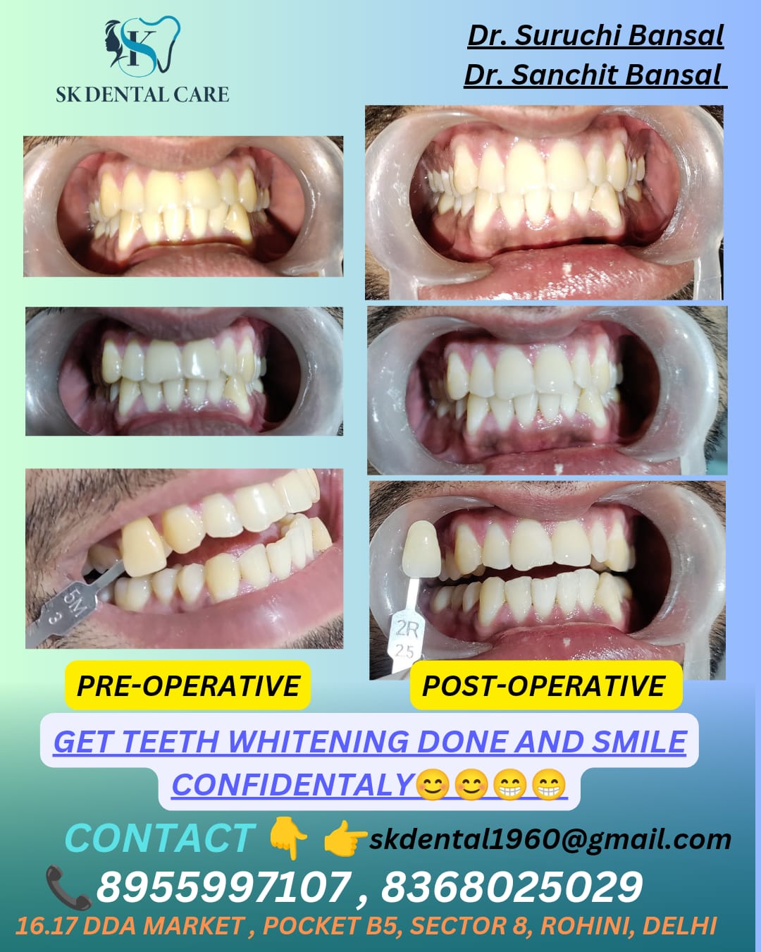 Teeth Whitening Treatment